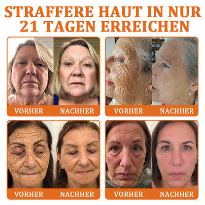 👨‍⚕️BfArM-ZULASSUNG | 🐝Flysmus™ Botox Bienengift Behandlung Serum Stick: Zielt auf Warzen, Dunkle Flecken & Narben ab, Strafft Falten
