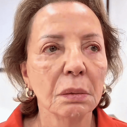 👨‍⚕️BfArM-ZULASSUNG | 🐝Flysmus™ Botox Bienengift Behandlung Serum Stick: Zielt auf Warzen, Dunkle Flecken & Narben ab, Strafft Falten