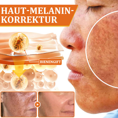👨‍⚕️BfArM-ZULASSUNG | 🐝Flysmus™ Botox Bienengift Behandlung Serum Stick: Zielt auf Warzen, Dunkle Flecken & Narben ab, Strafft Falten