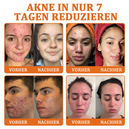 👨‍⚕️BfArM-ZULASSUNG | 🐝Flysmus™ Botox Bienengift Behandlung Serum Stick: Zielt auf Warzen, Dunkle Flecken & Narben ab, Strafft Falten