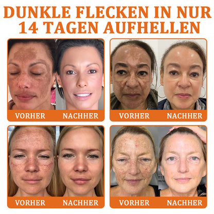 👨‍⚕️BfArM-ZULASSUNG | 🐝Flysmus™ Botox Bienengift Behandlung Serum Stick: Zielt auf Warzen, Dunkle Flecken & Narben ab, Strafft Falten